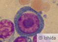 図2 がん化した異常なリンパ球