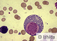 図3 がん化した赤血球を作る細胞